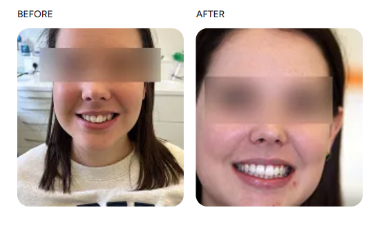 Clear aligner 2 before and after