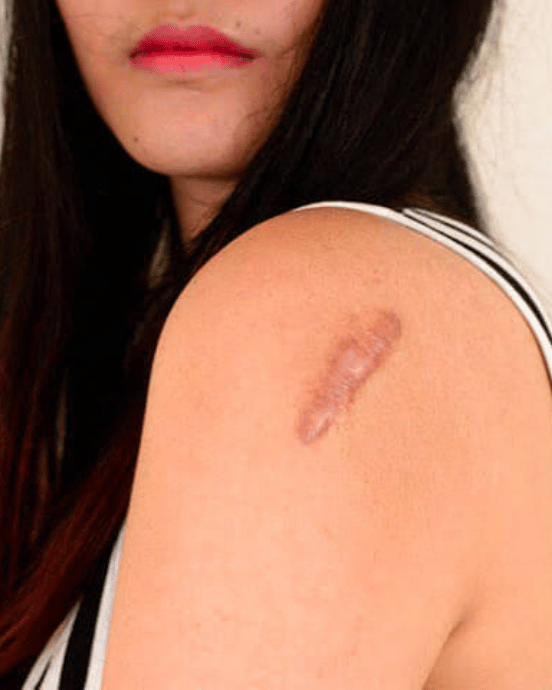 woman having keloids on her shoulder