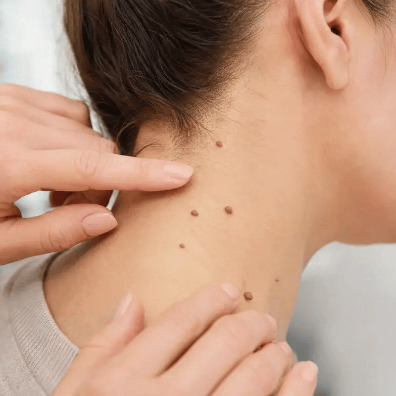 skin tag on a woman's neck