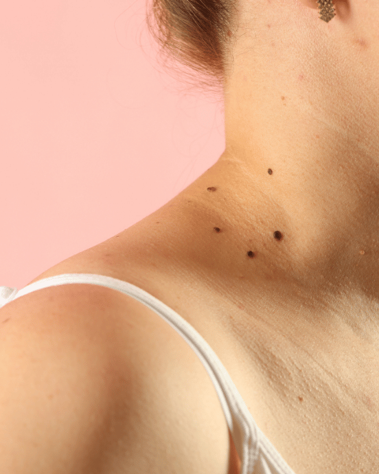 Skin Tag P